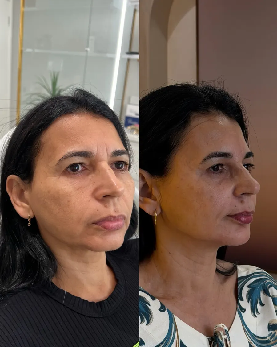 Full Face antes e depois, paciente acompanhada por dois anos