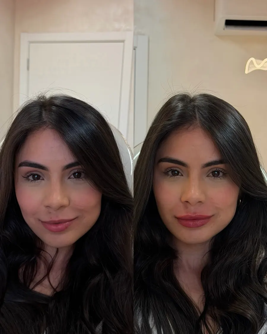 Preenchimento labial antes e depois